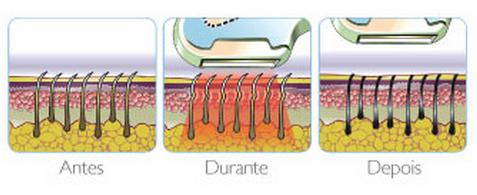 Fotodepilação A Depilação Definitiva Indolor E Baixo Custo